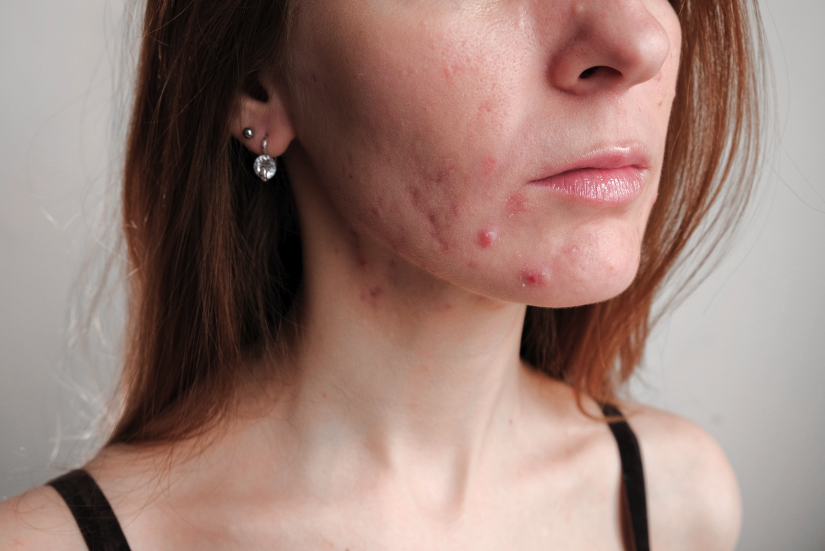 contributors-to-hormonal-acne.png